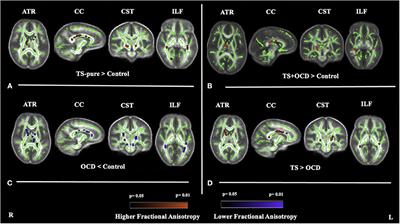 White matter alterations in drug-naïve children with Tourette syndrome and obsessive-compulsive disorder